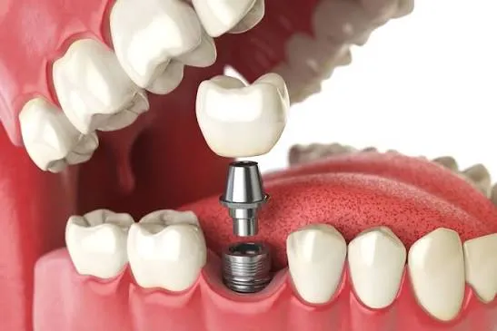 Implant Tooth Fixing